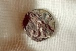 Zelenograd doctors pulled out a coin from a patient's nose that had been there for over 50 years
